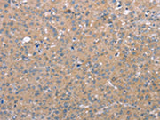 The image on the left is immunohistochemistry of paraffin-embedded Human liver cancer tissue using CSB-PA563396(CD97 Antibody) at dilution 1/25, on the right is treated with synthetic peptide. (Original magnification: ×200)