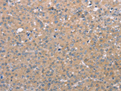 The image on the left is immunohistochemistry of paraffin-embedded Human liver cancer tissue using CSB-PA563396(CD97 Antibody) at dilution 1/25, on the right is treated with synthetic peptide. (Original magnification: ×200)