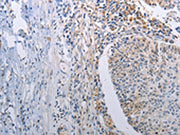 The image on the left is immunohistochemistry of paraffin-embedded Human lung cancer tissue using CSB-PA563679(STAT1 Antibody) at dilution 1/30, on the right is treated with fusion protein. (Original magnification: ×200)