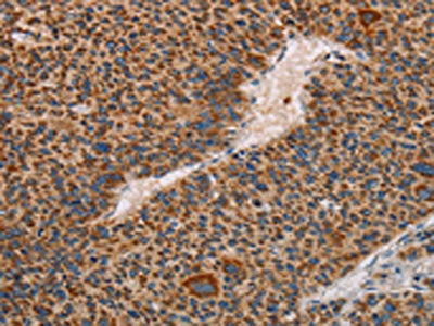 The image on the left is immunohistochemistry of paraffin-embedded Human liver cancer tissue using CSB-PA563995(MMP1 Antibody) at dilution 1/60, on the right is treated with fusion protein. (Original magnification: ×200)