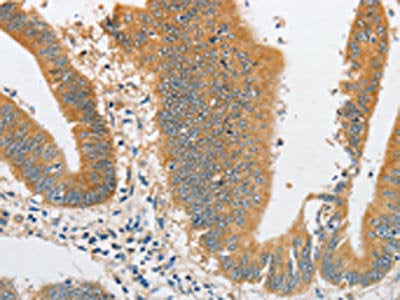 The image on the left is immunohistochemistry of paraffin-embedded Human colon cancer tissue using CSB-PA564021(ARHGAP5 Antibody) at dilution 1/30, on the right is treated with fusion protein. (Original magnification: ×200)