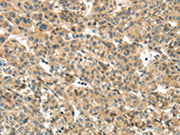 The image on the left is immunohistochemistry of paraffin-embedded Human liver cancer tissue using CSB-PA564055(TMEM161A Antibody) at dilution 1/30, on the right is treated with fusion protein. (Original magnification: ×200)