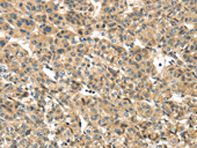 The image on the left is immunohistochemistry of paraffin-embedded Human liver cancer tissue using CSB-PA564055(TMEM161A Antibody) at dilution 1/30, on the right is treated with fusion protein. (Original magnification: ×200)