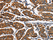 The image on the left is immunohistochemistry of paraffin-embedded Human breast cancer tissue using CSB-PA564388(EIF4EBP2 Antibody) at dilution 1/30, on the right is treated with fusion protein. (Original magnification: ×200)
