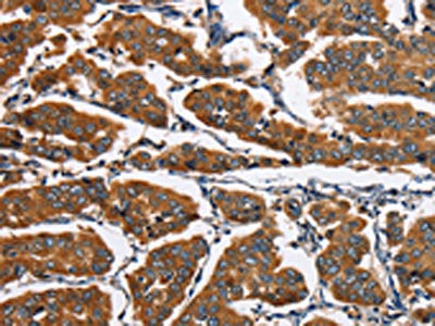 The image on the left is immunohistochemistry of paraffin-embedded Human breast cancer tissue using CSB-PA564388(EIF4EBP2 Antibody) at dilution 1/30, on the right is treated with fusion protein. (Original magnification: ×200)