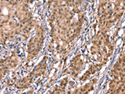 The image on the left is immunohistochemistry of paraffin-embedded Human gastic cancer tissue using CSB-PA564451(KCNJ6 Antibody) at dilution 1/40, on the right is treated with synthetic peptide. (Original magnification: ×200)