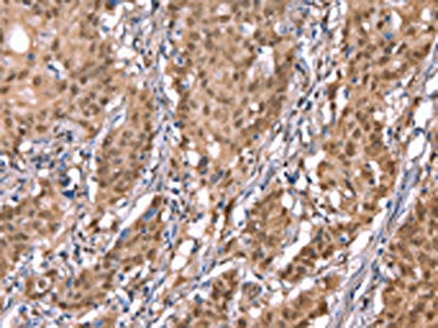 The image on the left is immunohistochemistry of paraffin-embedded Human gastic cancer tissue using CSB-PA564451(KCNJ6 Antibody) at dilution 1/40, on the right is treated with synthetic peptide. (Original magnification: ×200)