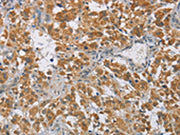 The image on the left is immunohistochemistry of paraffin-embedded Human thyroid cancer tissue using CSB-PA564510(DIDO1 Antibody) at dilution 1/60, on the right is treated with fusion protein. (Original magnification: ×200)