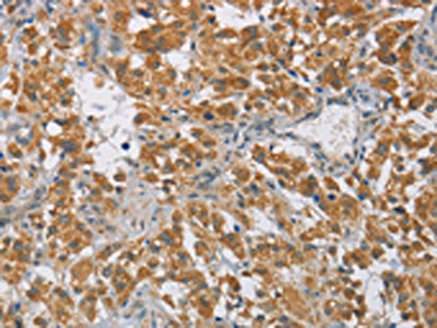 The image on the left is immunohistochemistry of paraffin-embedded Human thyroid cancer tissue using CSB-PA564510(DIDO1 Antibody) at dilution 1/60, on the right is treated with fusion protein. (Original magnification: ×200)