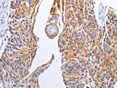 The image on the left is immunohistochemistry of paraffin-embedded Human esophagus cancer tissue using CSB-PA564725(LIPE Antibody) at dilution 1/10, on the right is treated with fusion protein. (Original magnification: ×200)