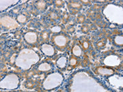The image on the left is immunohistochemistry of paraffin-embedded Human thyroid cancer tissue using CSB-PA564826(SLC25A1 Antibody) at dilution 1/25, on the right is treated with fusion protein. (Original magnification: ×200)
