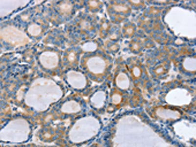 The image on the left is immunohistochemistry of paraffin-embedded Human thyroid cancer tissue using CSB-PA564826(SLC25A1 Antibody) at dilution 1/25, on the right is treated with fusion protein. (Original magnification: ×200)