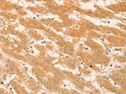 The image on the left is immunohistochemistry of paraffin-embedded Human liver cancer tissue using CSB-PA565139(NAP1L1 Antibody) at dilution 1/50, on the right is treated with fusion protein. (Original magnification: ×200)