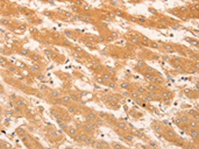 The image on the left is immunohistochemistry of paraffin-embedded Human liver cancer tissue using CSB-PA565139(NAP1L1 Antibody) at dilution 1/50, on the right is treated with fusion protein. (Original magnification: ×200)