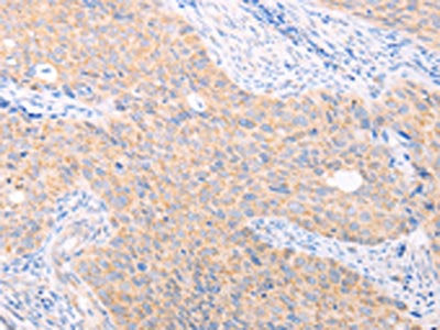 The image on the left is immunohistochemistry of paraffin-embedded Human cervical cancer tissue using CSB-PA565209(TRIM32 Antibody) at dilution 1/40, on the right is treated with fusion protein. (Original magnification: ×200)
