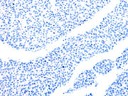 The image on the left is immunohistochemistry of paraffin-embedded Human liver cancer tissue using CSB-PA565356(MT-CO2 Antibody) at dilution 1/6, on the right is treated with synthetic peptide. (Original magnification: ×200)