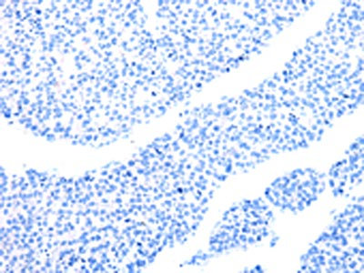 The image on the left is immunohistochemistry of paraffin-embedded Human liver cancer tissue using CSB-PA565356(MT-CO2 Antibody) at dilution 1/6, on the right is treated with synthetic peptide. (Original magnification: ×200)