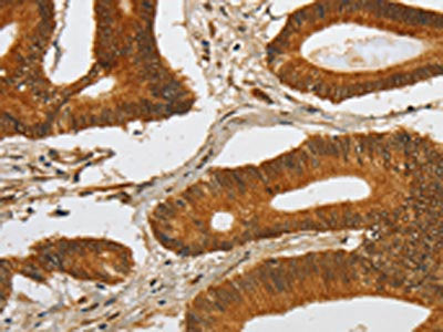 The image on the left is immunohistochemistry of paraffin-embedded Human colon cancer tissue using CSB-PA565390(SPHK2 Antibody) at dilution 1/80, on the right is treated with fusion protein. (Original magnification: ×200)