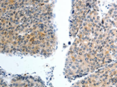 The image on the left is immunohistochemistry of paraffin-embedded Human liver cancer tissue using CSB-PA565630(SLC22A3 Antibody) at dilution 1/40, on the right is treated with synthetic peptide. (Original magnification: ×200)