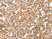 The image on the left is immunohistochemistry of paraffin-embedded Human thyroid cancer tissue using CSB-PA565667(CYP46A1 Antibody) at dilution 1/15, on the right is treated with synthetic peptide. (Original magnification: ×200)
