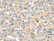 The image on the left is immunohistochemistry of paraffin-embedded Human liver cancer tissue using CSB-PA565802(TMPRSS11B Antibody) at dilution 1/20, on the right is treated with fusion protein. (Original magnification: ×200)