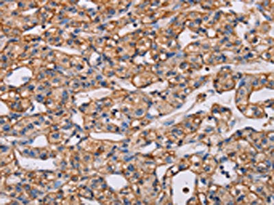 The image on the left is immunohistochemistry of paraffin-embedded Human prostate cancer tissue using CSB-PA565827(ARAP1 Antibody) at dilution 1/40, on the right is treated with synthetic peptide. (Original magnification: ×200)