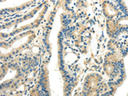 The image on the left is immunohistochemistry of paraffin-embedded Human thyroid cancer tissue using CSB-PA565878(WNK1 Antibody) at dilution 1/25, on the right is treated with synthetic peptide. (Original magnification: ×200)