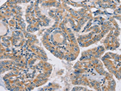The image on the left is immunohistochemistry of paraffin-embedded Human thyroid cancer tissue using CSB-PA566010(RAB21 Antibody) at dilution 1/35, on the right is treated with synthetic peptide. (Original magnification: ×200)