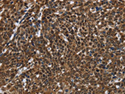 The image on the left is immunohistochemistry of paraffin-embedded Human cervical cancer tissue using CSB-PA566041(FASTKD2 Antibody) at dilution 1/50, on the right is treated with fusion protein. (Original magnification: ×200)