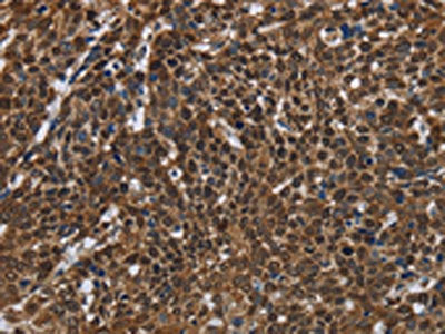The image on the left is immunohistochemistry of paraffin-embedded Human cervical cancer tissue using CSB-PA566041(FASTKD2 Antibody) at dilution 1/50, on the right is treated with fusion protein. (Original magnification: ×200)