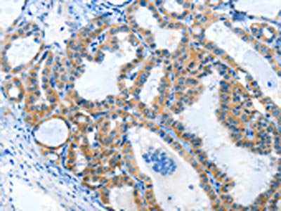 The image on the left is immunohistochemistry of paraffin-embedded Human thyroid cancer tissue using CSB-PA566307(ANKMY1 Antibody) at dilution 1/25, on the right is treated with fusion protein. (Original magnification: ×200)