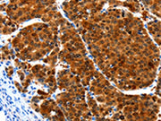 The image on the left is immunohistochemistry of paraffin-embedded Human liver cancer tissue using CSB-PA566343(HIBADH Antibody) at dilution 1/25, on the right is treated with synthetic peptide. (Original magnification: ×200)