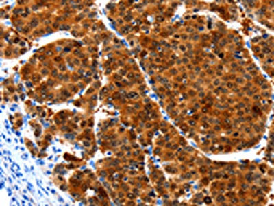 The image on the left is immunohistochemistry of paraffin-embedded Human liver cancer tissue using CSB-PA566343(HIBADH Antibody) at dilution 1/25, on the right is treated with synthetic peptide. (Original magnification: ×200)