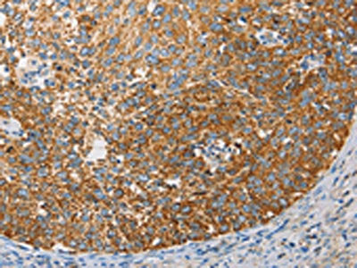 The image on the left is immunohistochemistry of paraffin-embedded Human cervical cancer tissue using CSB-PA566518(APOBEC3G Antibody) at dilution 1/50, on the right is treated with fusion protein. (Original magnification: ×200)