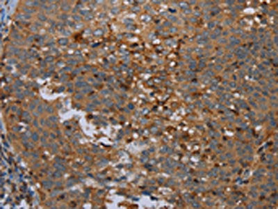 The image on the left is immunohistochemistry of paraffin-embedded Human cervical cancer tissue using CSB-PA566603(OTOR Antibody) at dilution 1/30, on the right is treated with synthetic peptide. (Original magnification: ×200)