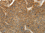 The image on the left is immunohistochemistry of paraffin-embedded Human liver cancer tissue using CSB-PA566617(PRKCA Antibody) at dilution 1/10, on the right is treated with fusion protein. (Original magnification: ×200)