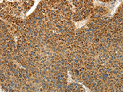 The image on the left is immunohistochemistry of paraffin-embedded Human liver cancer tissue using CSB-PA566617(PRKCA Antibody) at dilution 1/10, on the right is treated with fusion protein. (Original magnification: ×200)