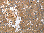The image on the left is immunohistochemistry of paraffin-embedded Human breast cancer tissue using CSB-PA566766(MMP27 Antibody) at dilution 1/50, on the right is treated with synthetic peptide. (Original magnification: ×200)