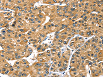 The image on the left is immunohistochemistry of paraffin-embedded Human liver cancer tissue using CSB-PA567041(PRSS50 Antibody) at dilution 1/30, on the right is treated with synthetic peptide. (Original magnification: ×200)