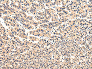 The image on the left is immunohistochemistry of paraffin-embedded Human liver cancer tissue using CSB-PA567081(VPS37A Antibody) at dilution 1/20, on the right is treated with fusion protein. (Original magnification: ×200)
