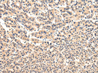 The image on the left is immunohistochemistry of paraffin-embedded Human liver cancer tissue using CSB-PA567081(VPS37A Antibody) at dilution 1/20, on the right is treated with fusion protein. (Original magnification: ×200)
