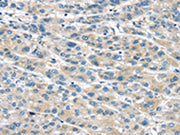The image on the left is immunohistochemistry of paraffin-embedded Human liver cancer tissue using CSB-PA567120(TRPM2 Antibody) at dilution 1/30, on the right is treated with fusion protein. (Original magnification: ×200)