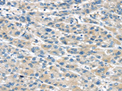 The image on the left is immunohistochemistry of paraffin-embedded Human liver cancer tissue using CSB-PA567120(TRPM2 Antibody) at dilution 1/30, on the right is treated with fusion protein. (Original magnification: ×200)