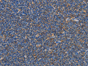 The image on the left is immunohistochemistry of paraffin-embedded Human Lymphoma tissue using CSB-PA567196(CARD6 Antibody) at dilution 1/60, on the right is treated with synthetic peptide. (Original magnification: ×200)