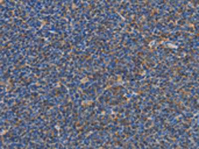 The image on the left is immunohistochemistry of paraffin-embedded Human Lymphoma tissue using CSB-PA567196(CARD6 Antibody) at dilution 1/60, on the right is treated with synthetic peptide. (Original magnification: ×200)
