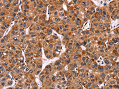 The image on the left is immunohistochemistry of paraffin-embedded Human liver cancer tissue using CSB-PA567327(CARD11 Antibody) at dilution 1/40, on the right is treated with fusion protein. (Original magnification: ×200)
