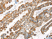 The image on the left is immunohistochemistry of paraffin-embedded Human esophagus cancer tissue using CSB-PA567337(LOXL4 Antibody) at dilution 1/35, on the right is treated with synthetic peptide. (Original magnification: ×200)