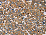 The image is immunohistochemistry of paraffin-embedded Human thyroid cancer tissue using CSB-PA567465(MBNL3 Antibody) at dilution 1/20. (Original magnification: ×200)