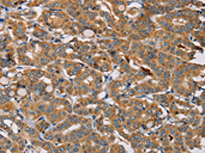 The image is immunohistochemistry of paraffin-embedded Human thyroid cancer tissue using CSB-PA567465(MBNL3 Antibody) at dilution 1/20. (Original magnification: ×200)