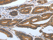 The image on the left is immunohistochemistry of paraffin-embedded Human colon cancer tissue using CSB-PA568085(PODXL Antibody) at dilution 1/25, on the right is treated with synthetic peptide. (Original magnification: ×200)